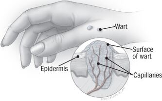 Struktura bradavice na ruce